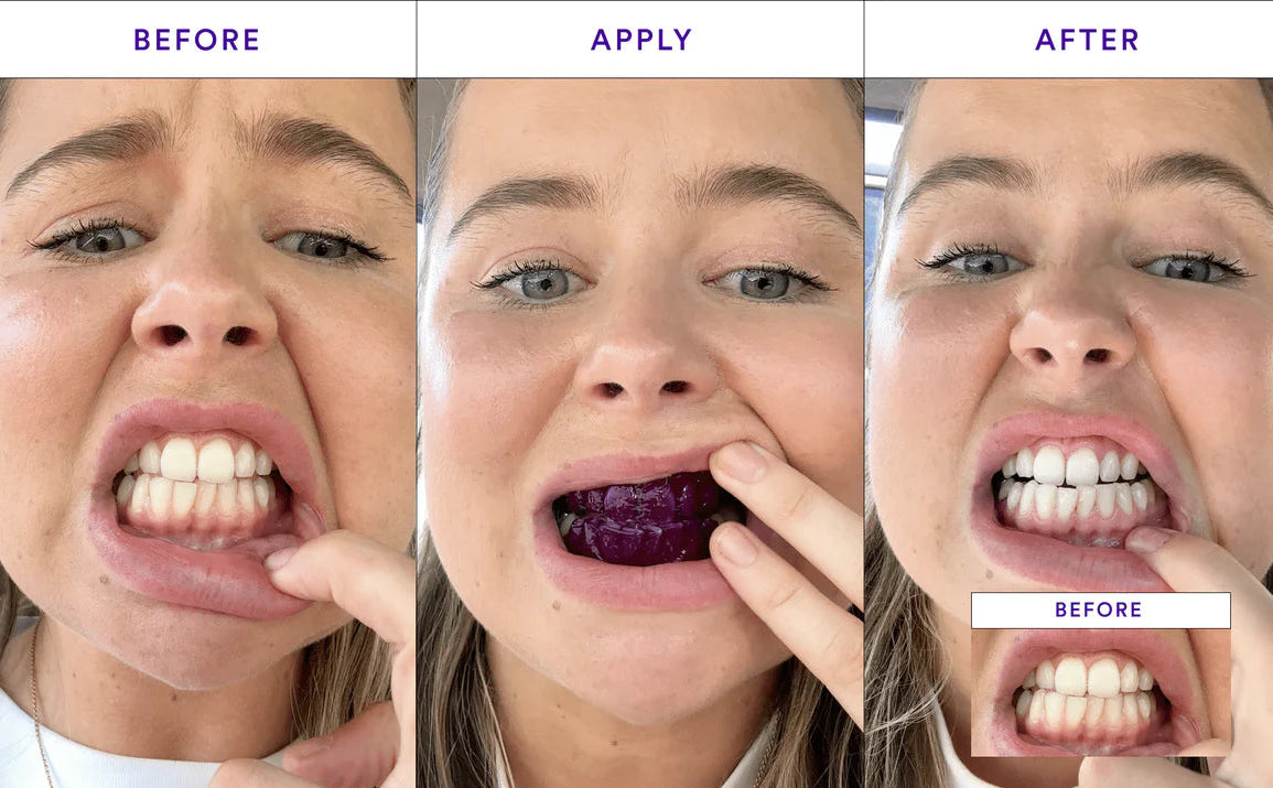 AlvdA PureWhite™ Whitening Strips